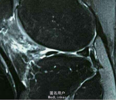 分析师：乌加特左膝疑似ACL+半月板损伤，或伤缺9-12个月5213